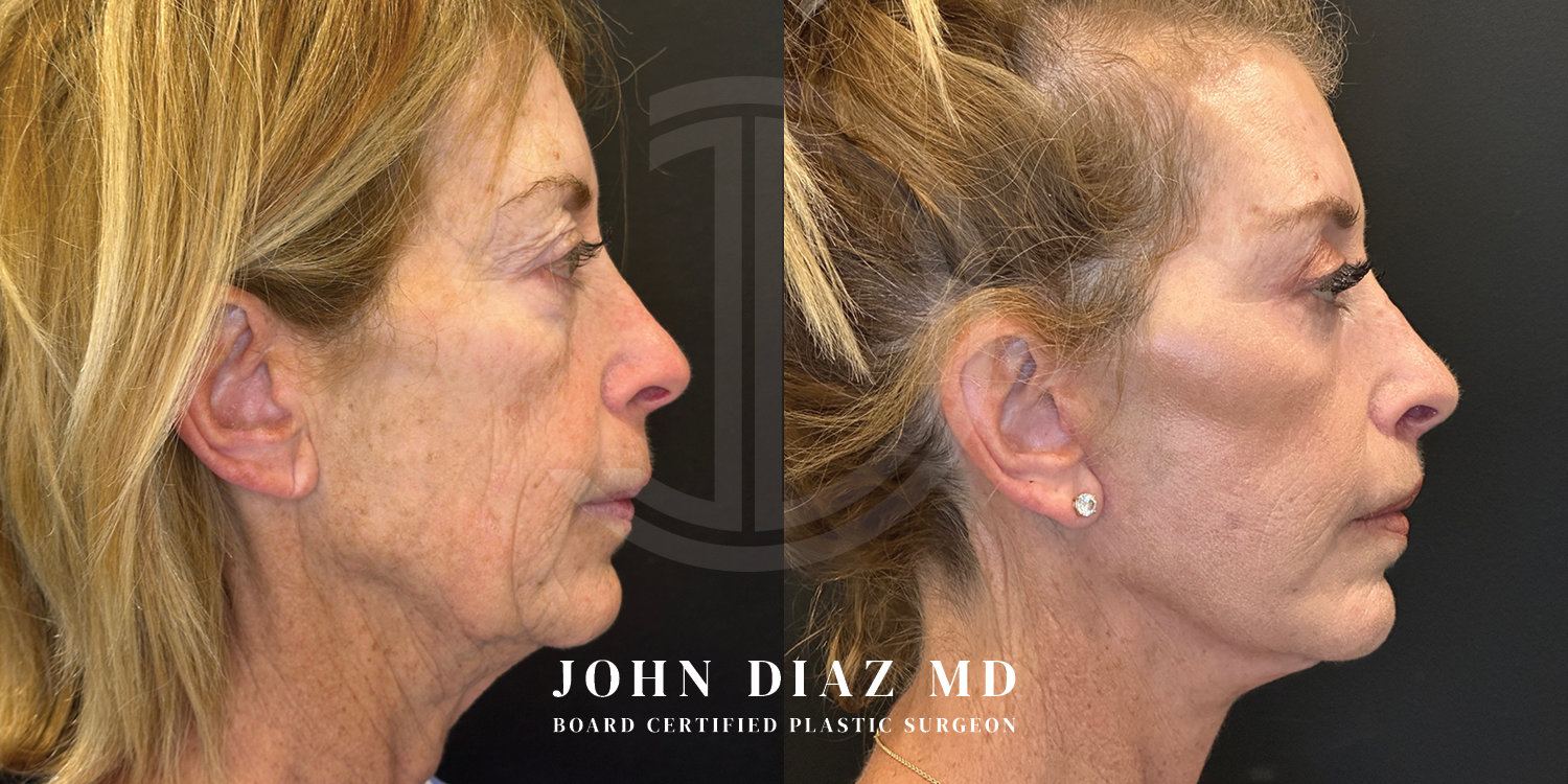 Dr John Diaz Facelift