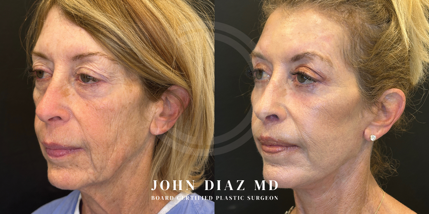 Dr John Diaz Facelift