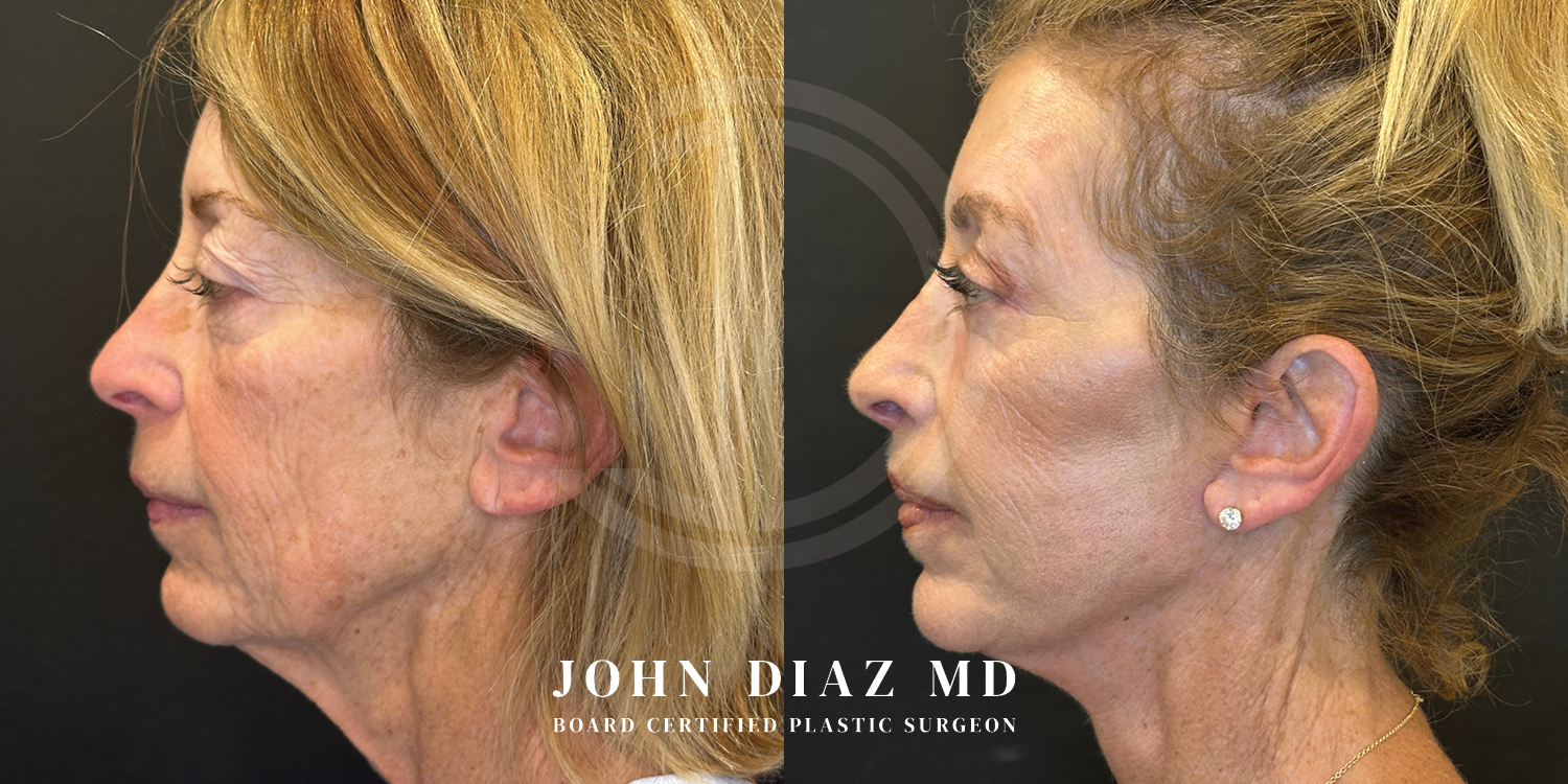 Dr John Diaz Facelift