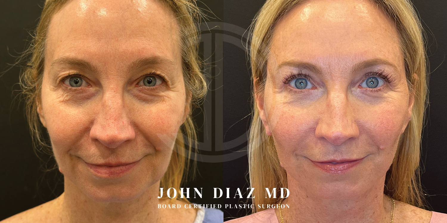 Dr John Diaz Facelift