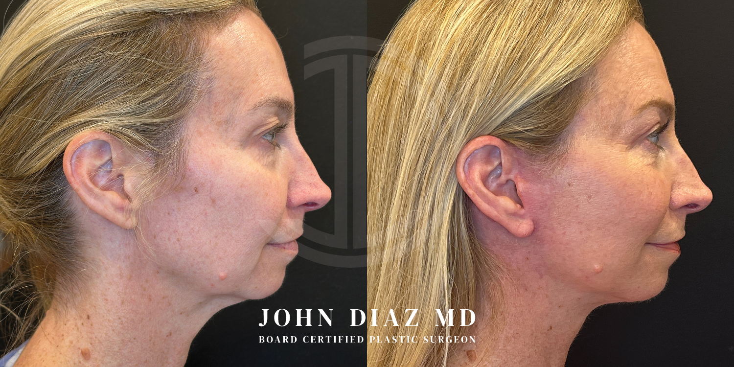 Dr John Diaz Facelift