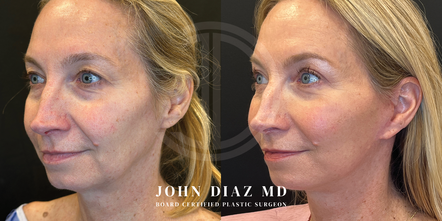 Dr John Diaz Facelift