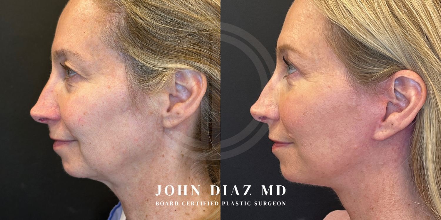Dr John Diaz Facelift