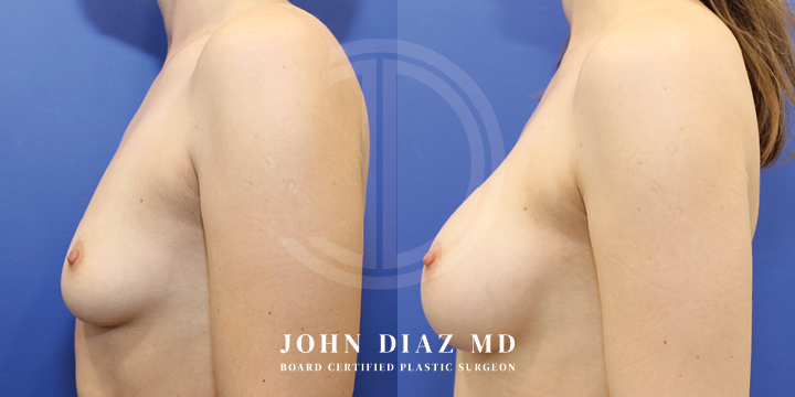 Dr John Diaz Before and After | Breast Lift
