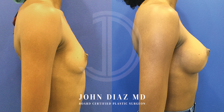 Dr John Diaz Before and After | Breast Lift