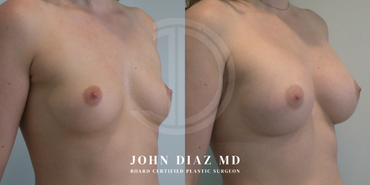 Dr John Diaz Before and After | Breast Lift