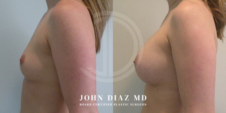 Dr John Diaz Before and After | Breast Lift