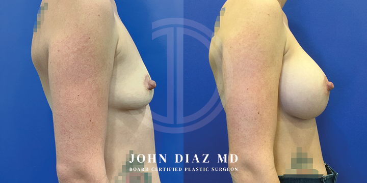 Dr John Diaz Before and After | Breast Lift