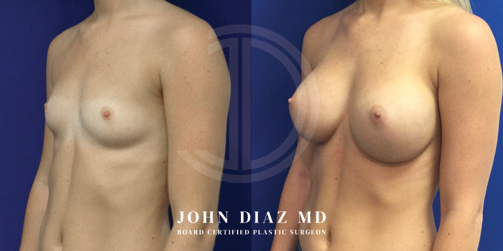 Dr John Diaz Before and After | Breast Lift