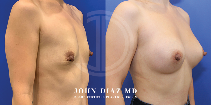 Dr John Diaz Before and After | Breast Lift