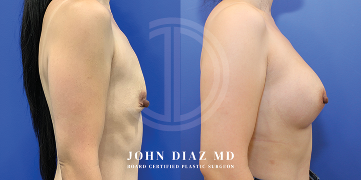 Dr John Diaz Before and After | Breast Lift