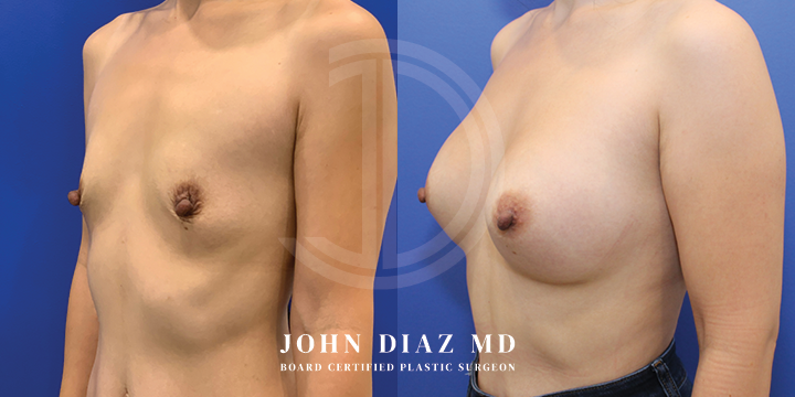 Dr John Diaz Before and After | Breast Lift