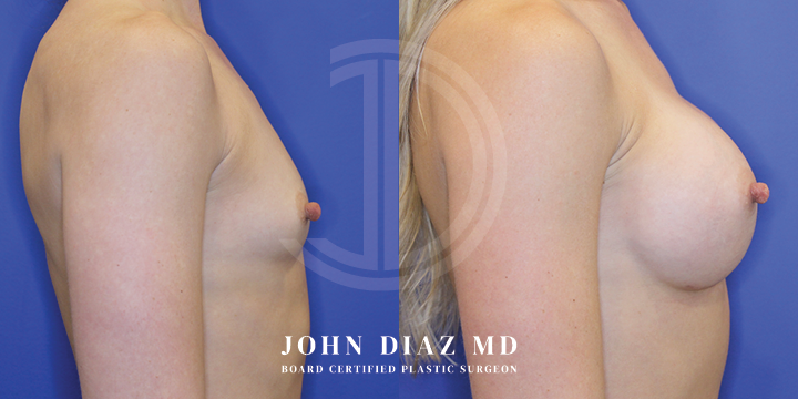 Dr John Diaz Before and After | Breast Lift