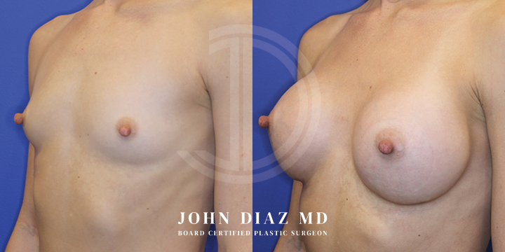 Dr John Diaz Before and After | Breast Lift