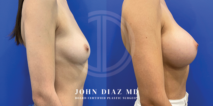 Dr John Diaz Before and After | Breast Lift