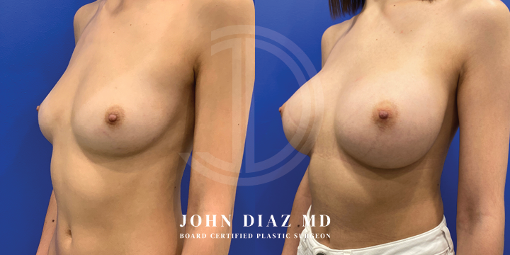 Dr John Diaz Before and After | Breast Lift