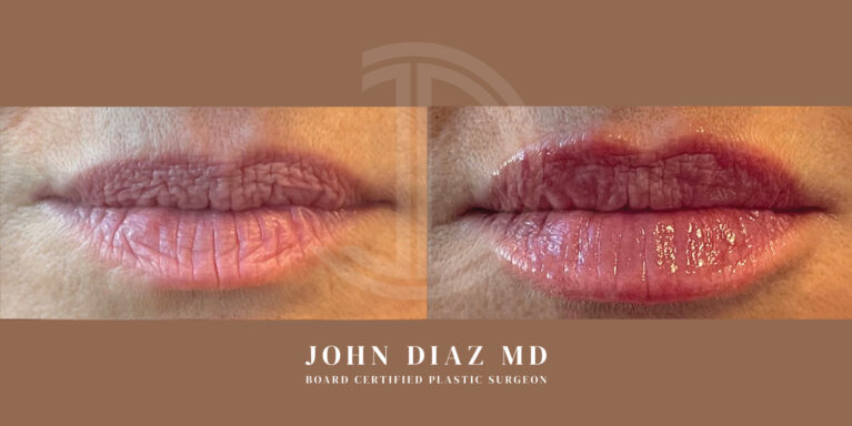 Dr John Diaz Medspa services - Lip Filler