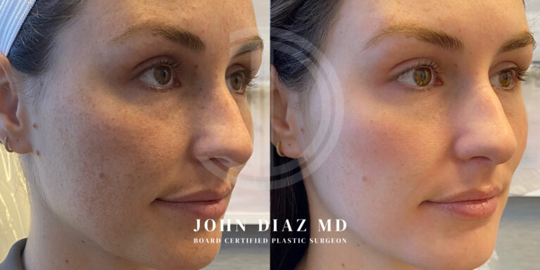 Dr John Diaz Medspa services - Facial Peels