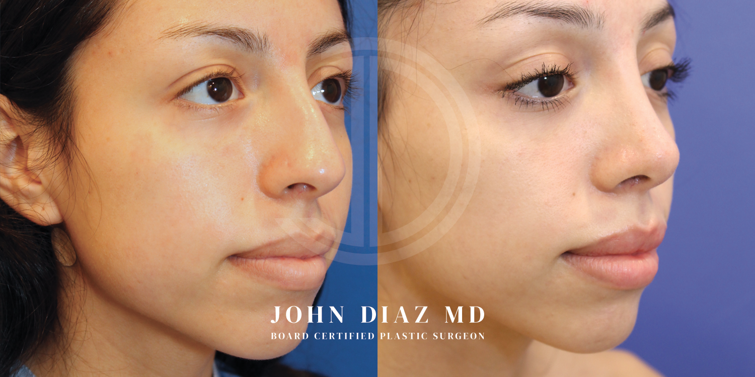 Dr John Diaz Before and After | Rhinoplasty