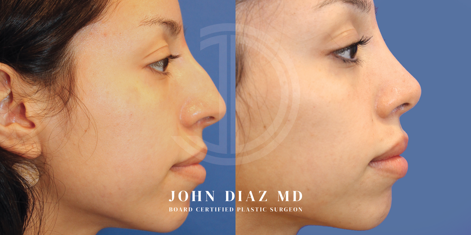 Dr John Diaz Before and After | Rhinoplasty