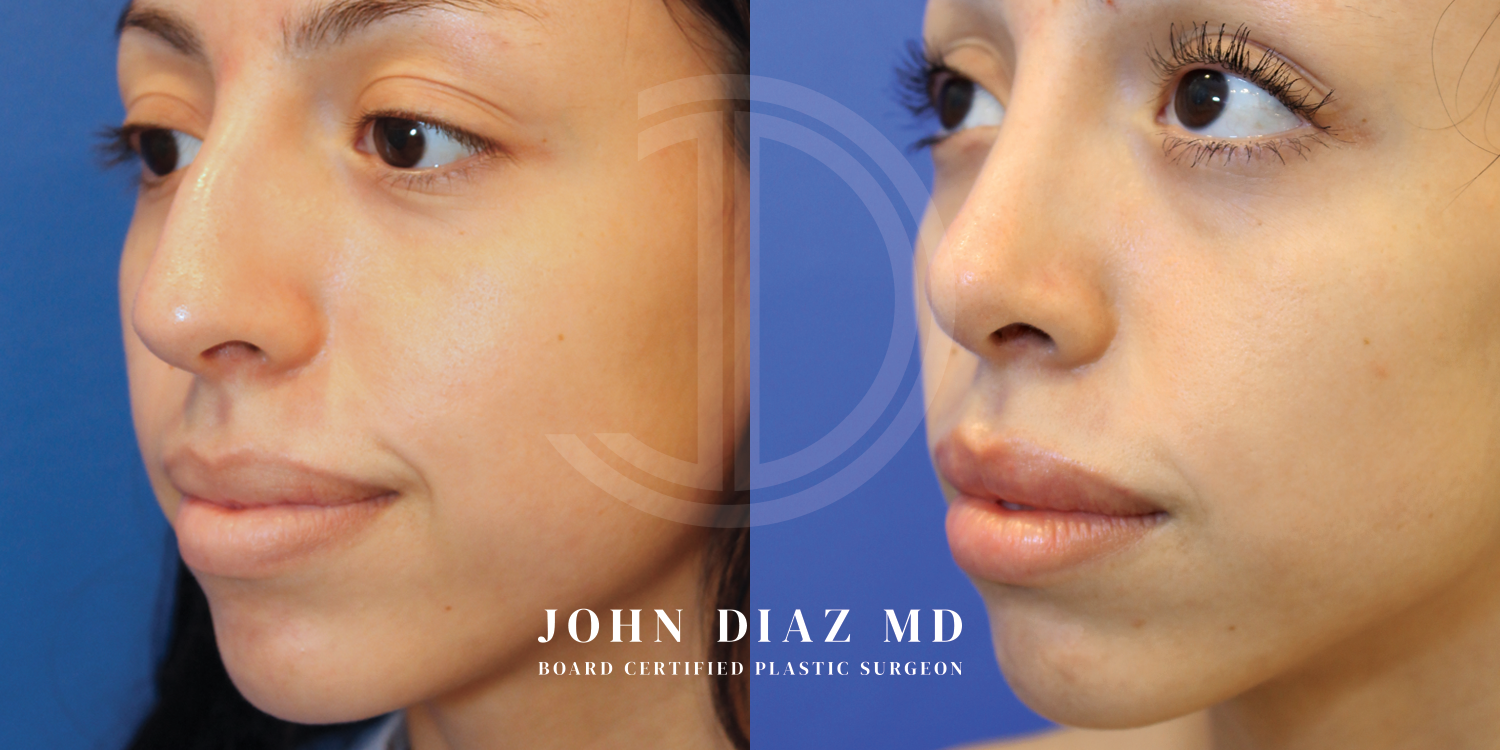 Dr John Diaz Before and After | Rhinoplasty