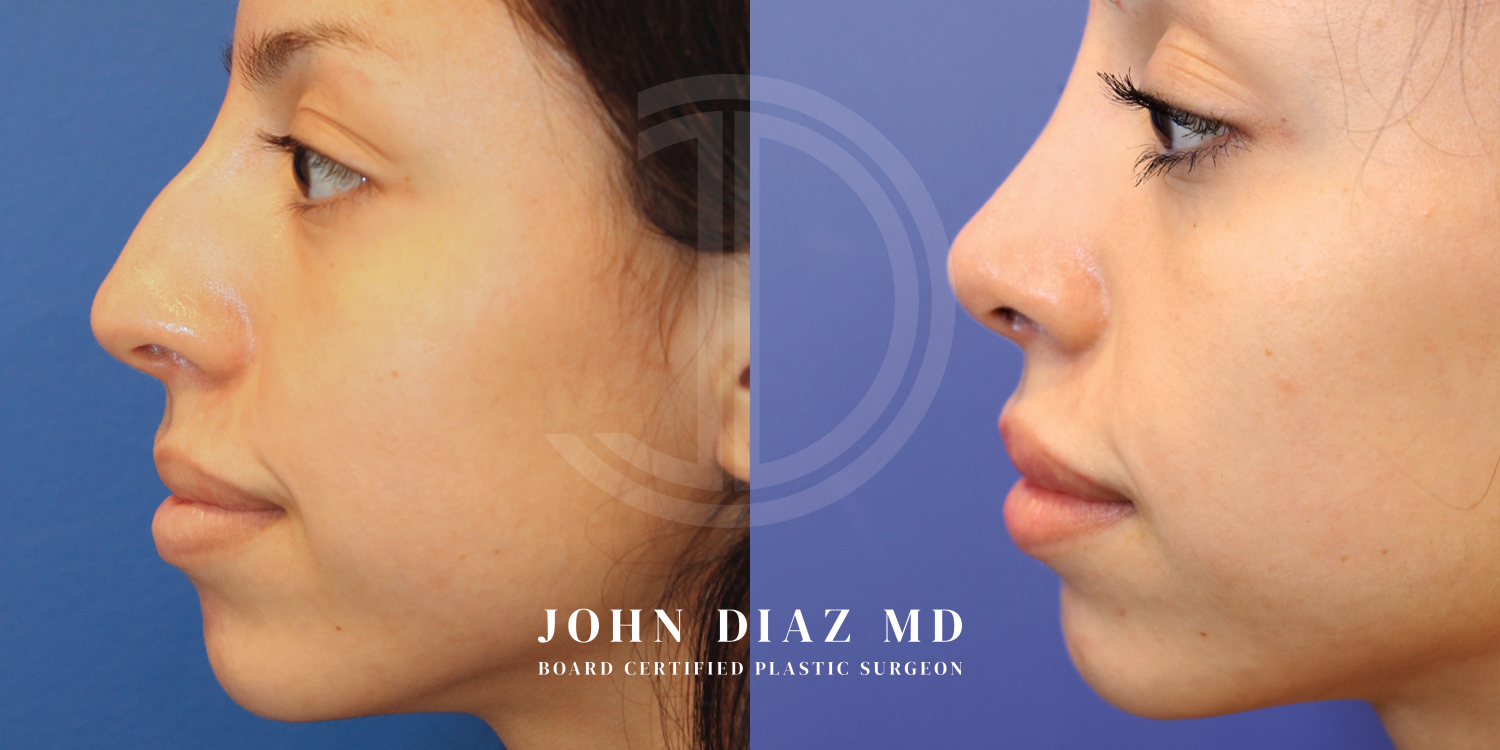 Dr John Diaz Before and After | Rhinoplasty