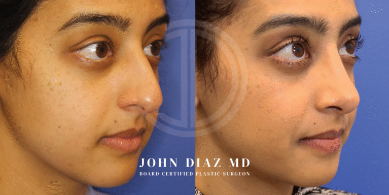 Dr John Diaz Before and After | Rhinoplasty