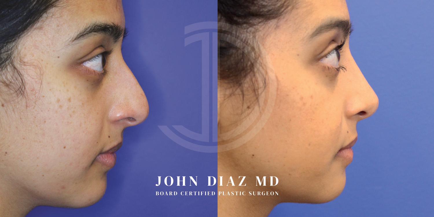 Dr John Diaz Before and After | Rhinoplasty