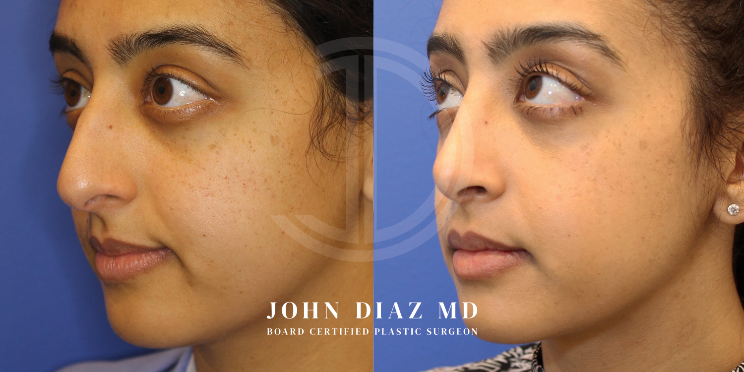 Dr John Diaz Before and After | Rhinoplasty