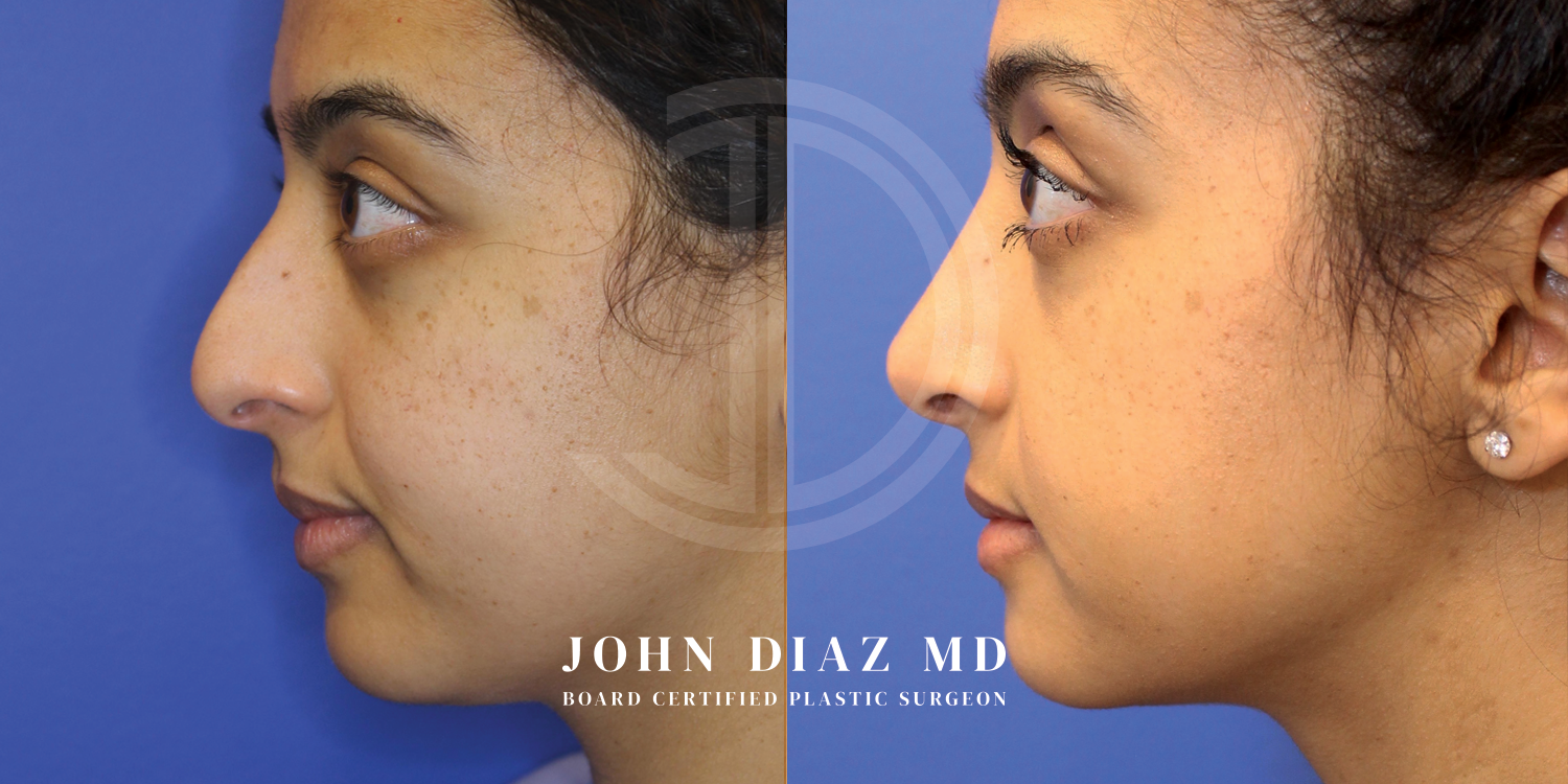 Dr John Diaz Before and After | Rhinoplasty
