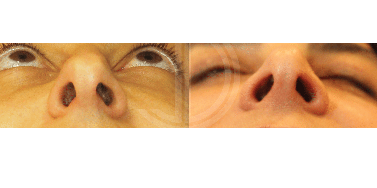 Dr John Diaz Before and After | Rhinoplasty