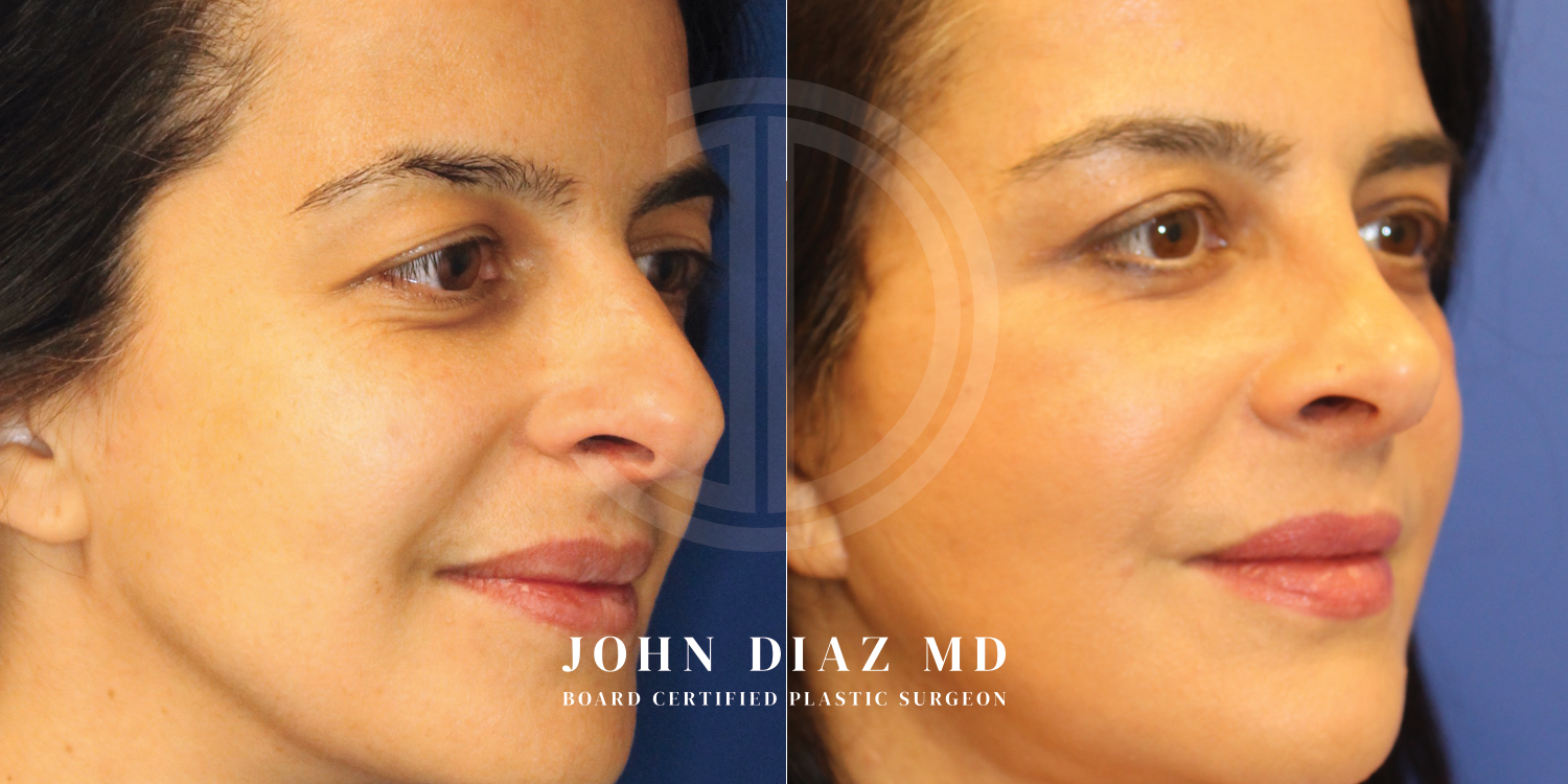 Dr John Diaz Before and After | Rhinoplasty