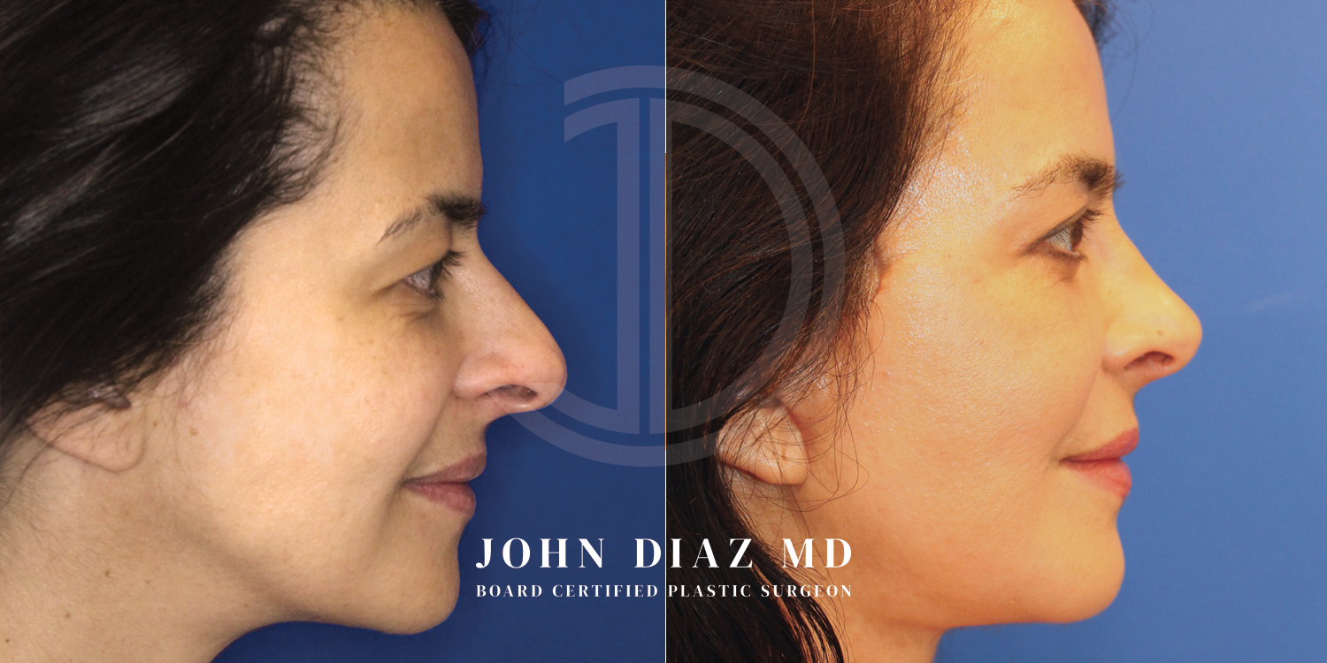Dr John Diaz Before and After | Rhinoplasty