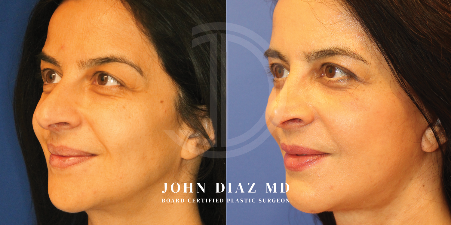Dr John Diaz Before and After | Rhinoplasty
