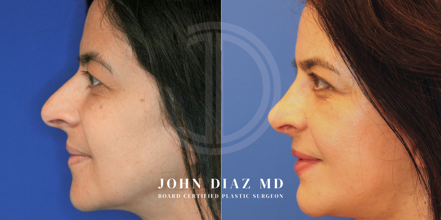 Dr John Diaz Before and After | Rhinoplasty