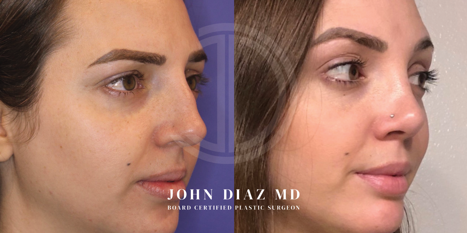 Dr John Diaz Before and After | Rhinoplasty