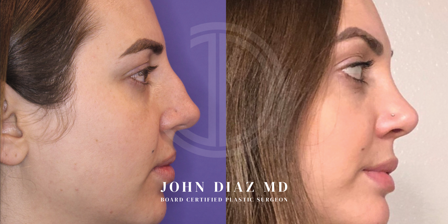 Dr John Diaz Before and After | Rhinoplasty