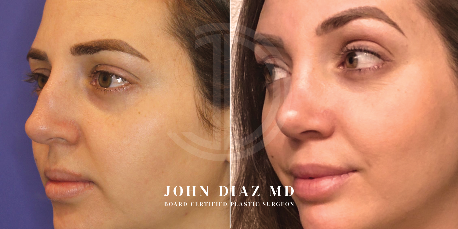 Dr John Diaz Before and After | Rhinoplasty