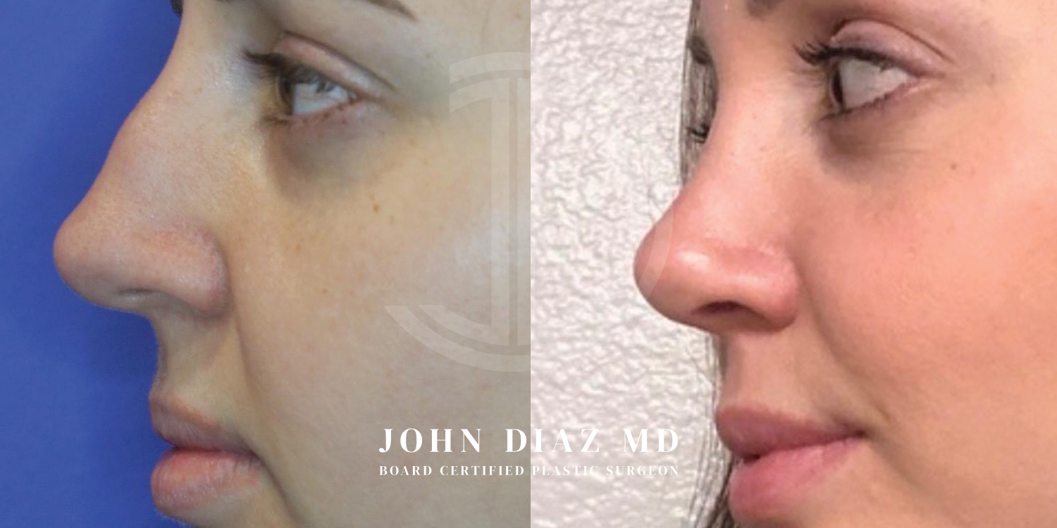 Dr John Diaz Before and After | Rhinoplasty