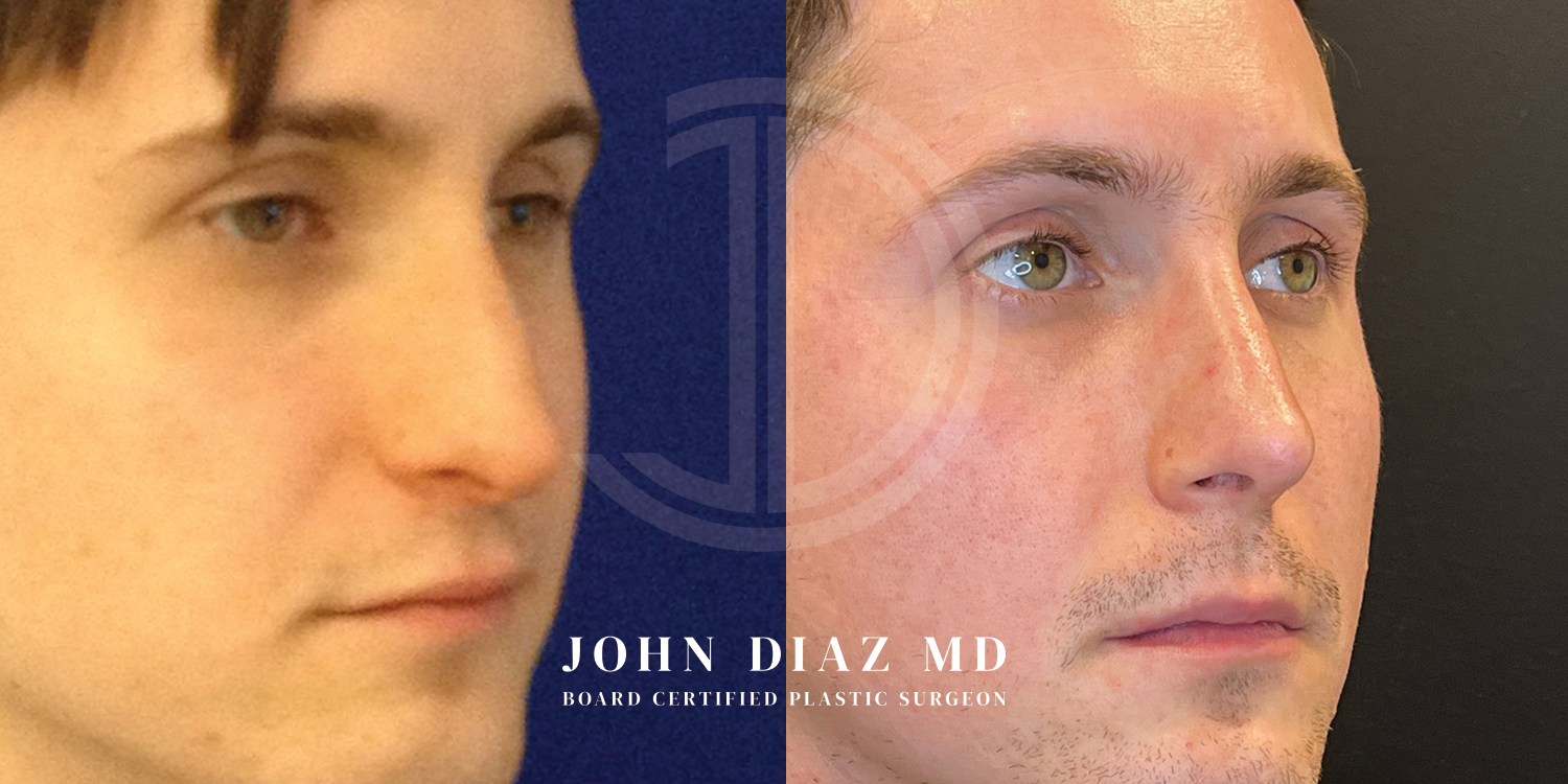 Dr John Diaz Before and After | Rhinoplasty
