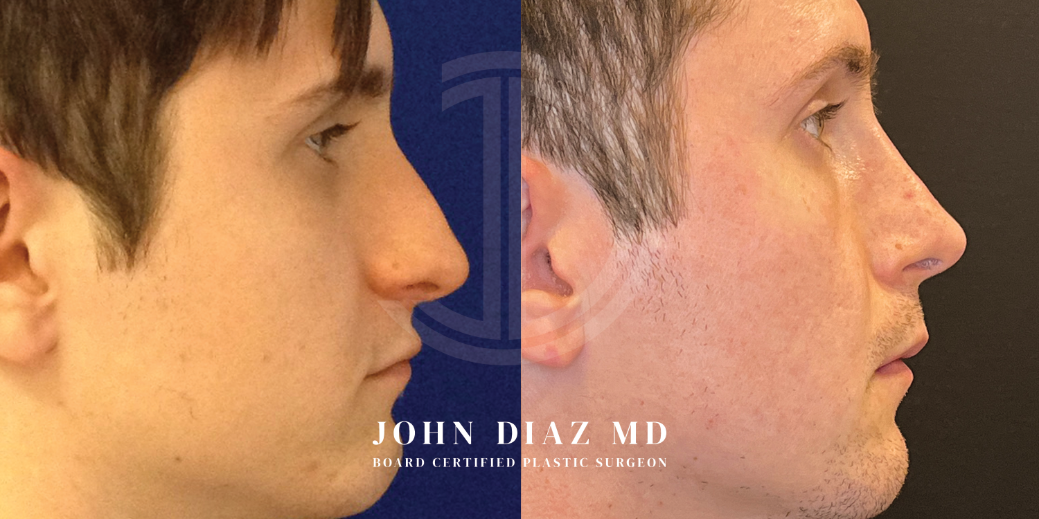 Dr John Diaz Before and After | Rhinoplasty
