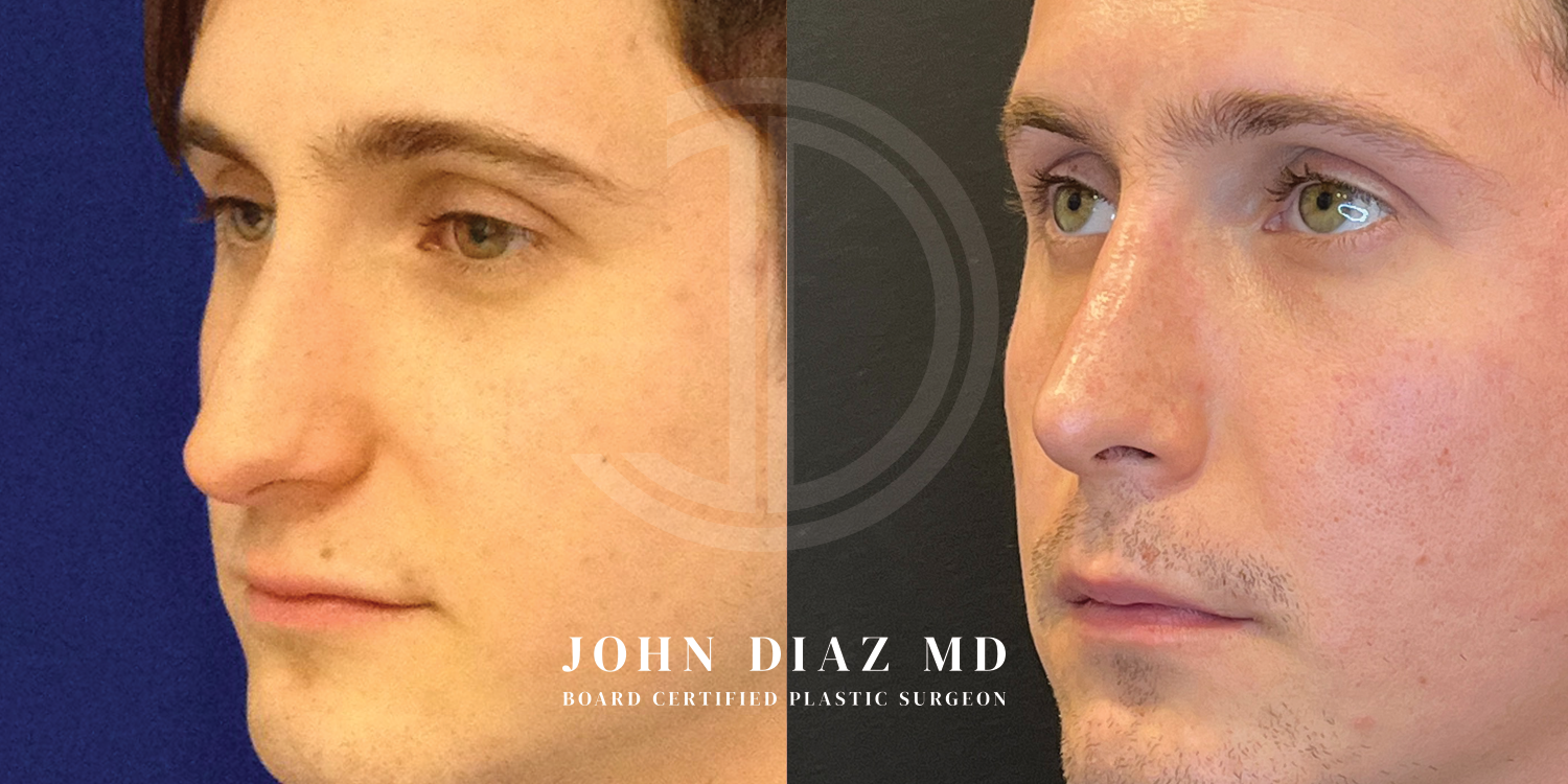 Dr John Diaz Before and After | Rhinoplasty