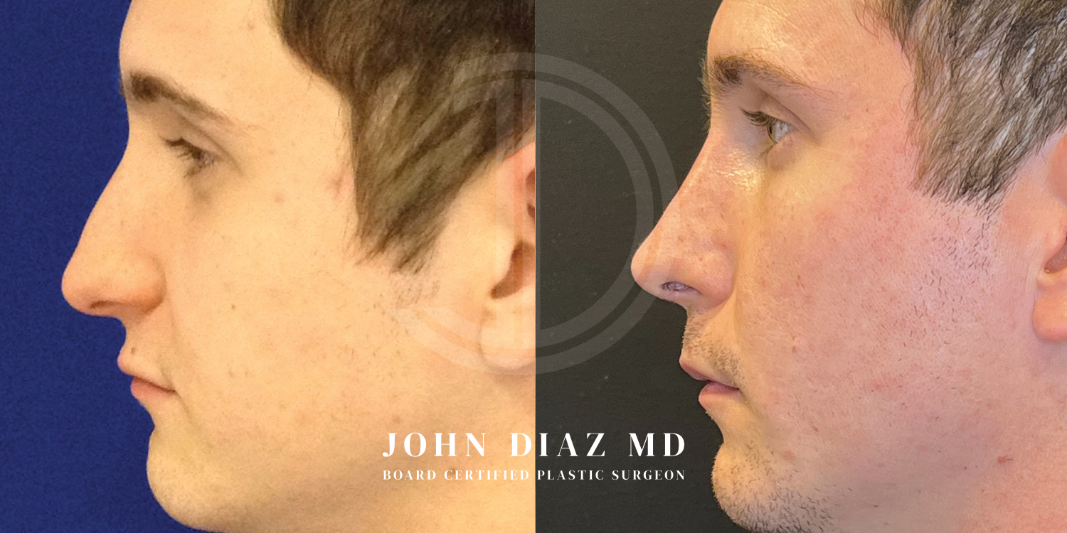Dr John Diaz Before and After | Rhinoplasty