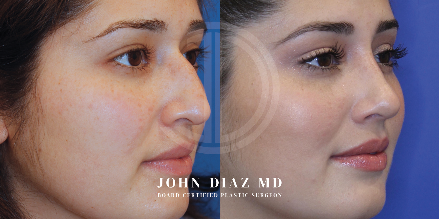 Dr John Diaz Before and After | Rhinoplasty