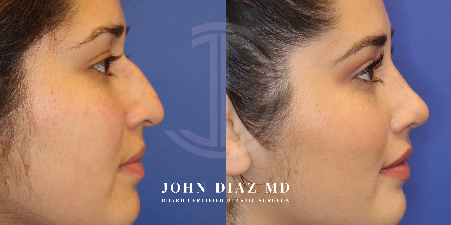 Dr John Diaz Before and After | Rhinoplasty