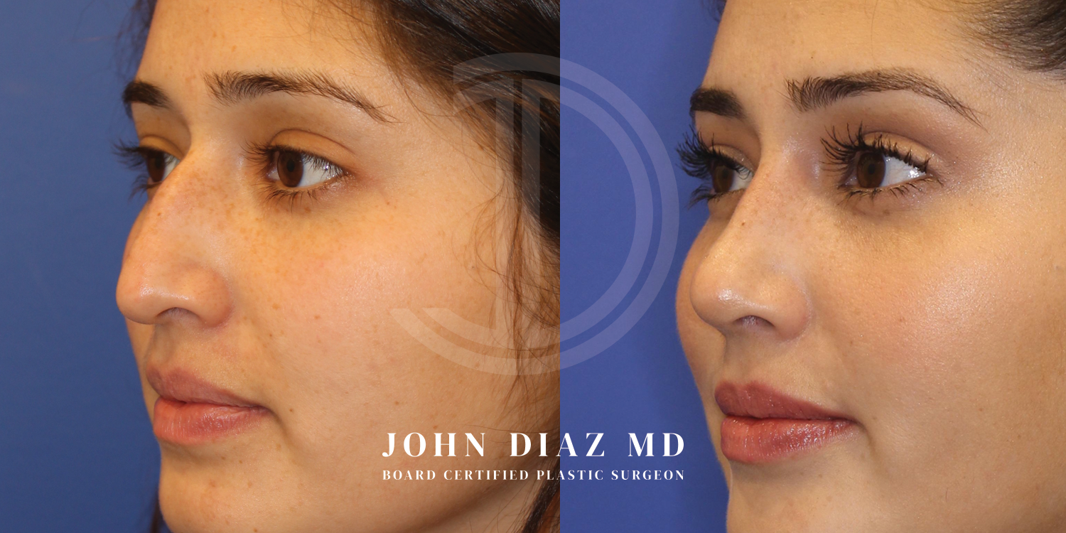 Dr John Diaz Before and After | Rhinoplasty