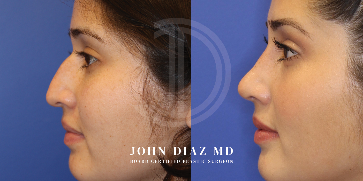 Dr John Diaz Before and After | Rhinoplasty