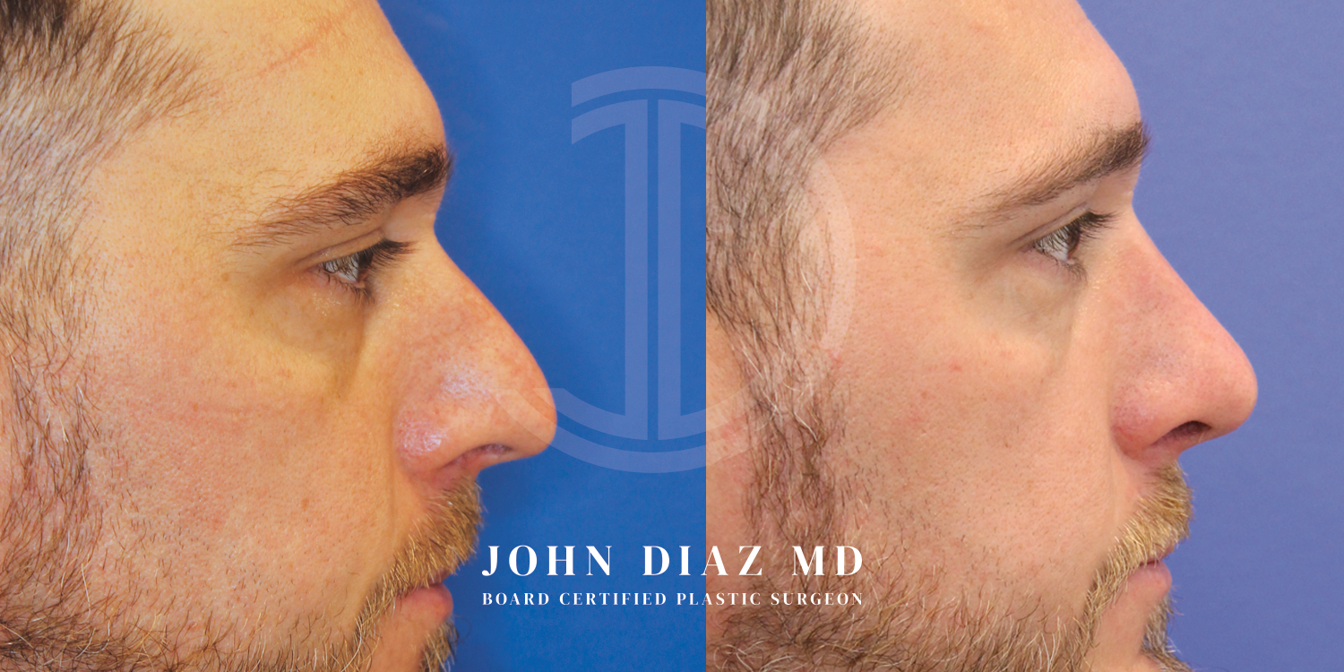 Dr John Diaz Before and After | Rhinoplasty