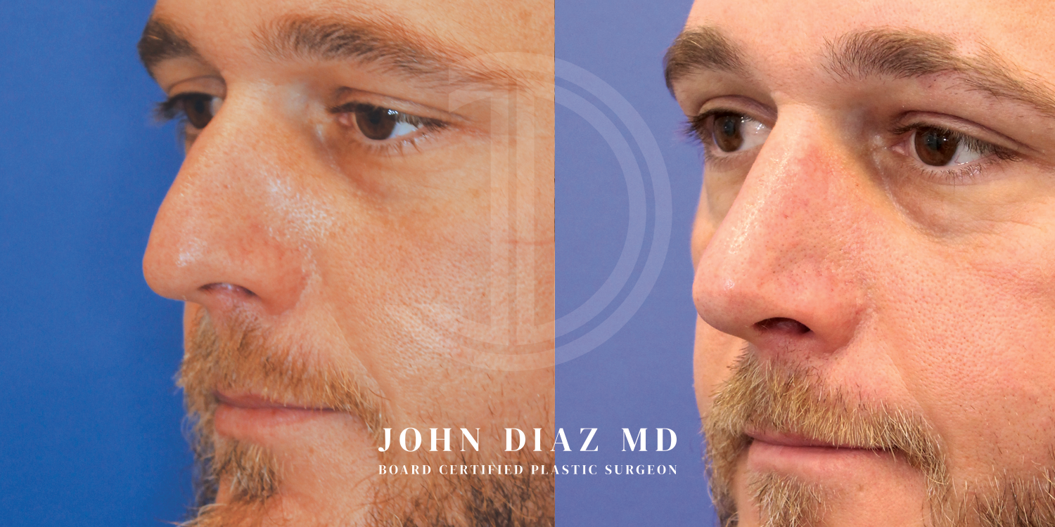 Dr John Diaz Before and After | Rhinoplasty