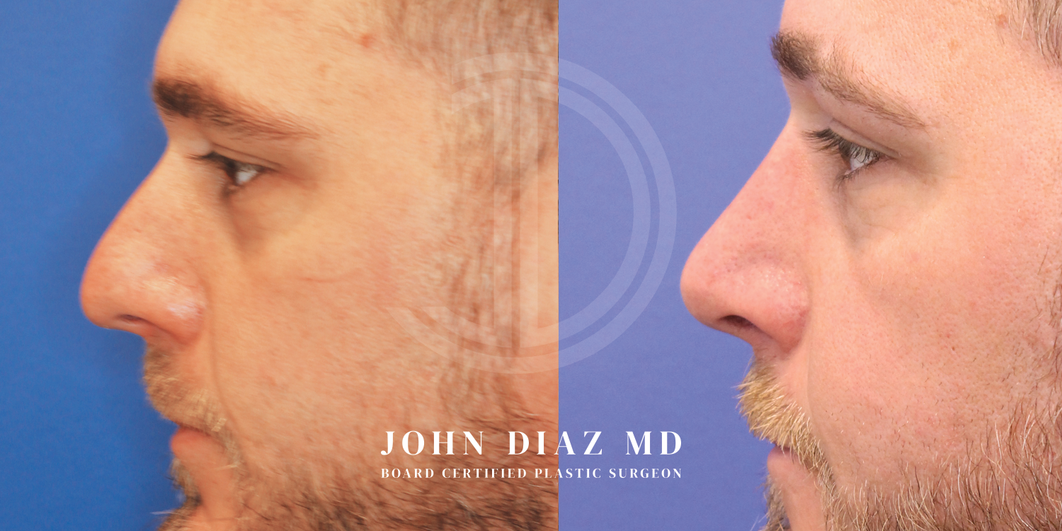 Dr John Diaz Before and After | Rhinoplasty
